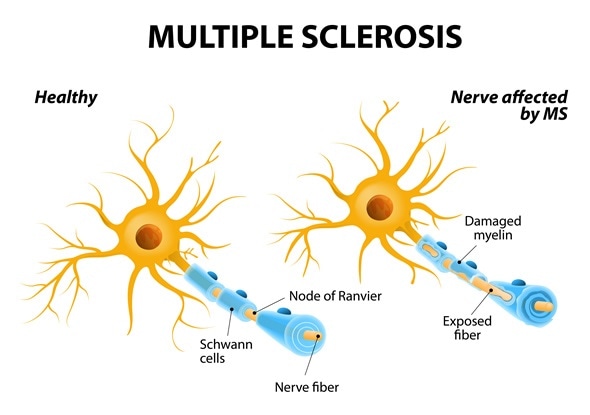 Damaged Nerve